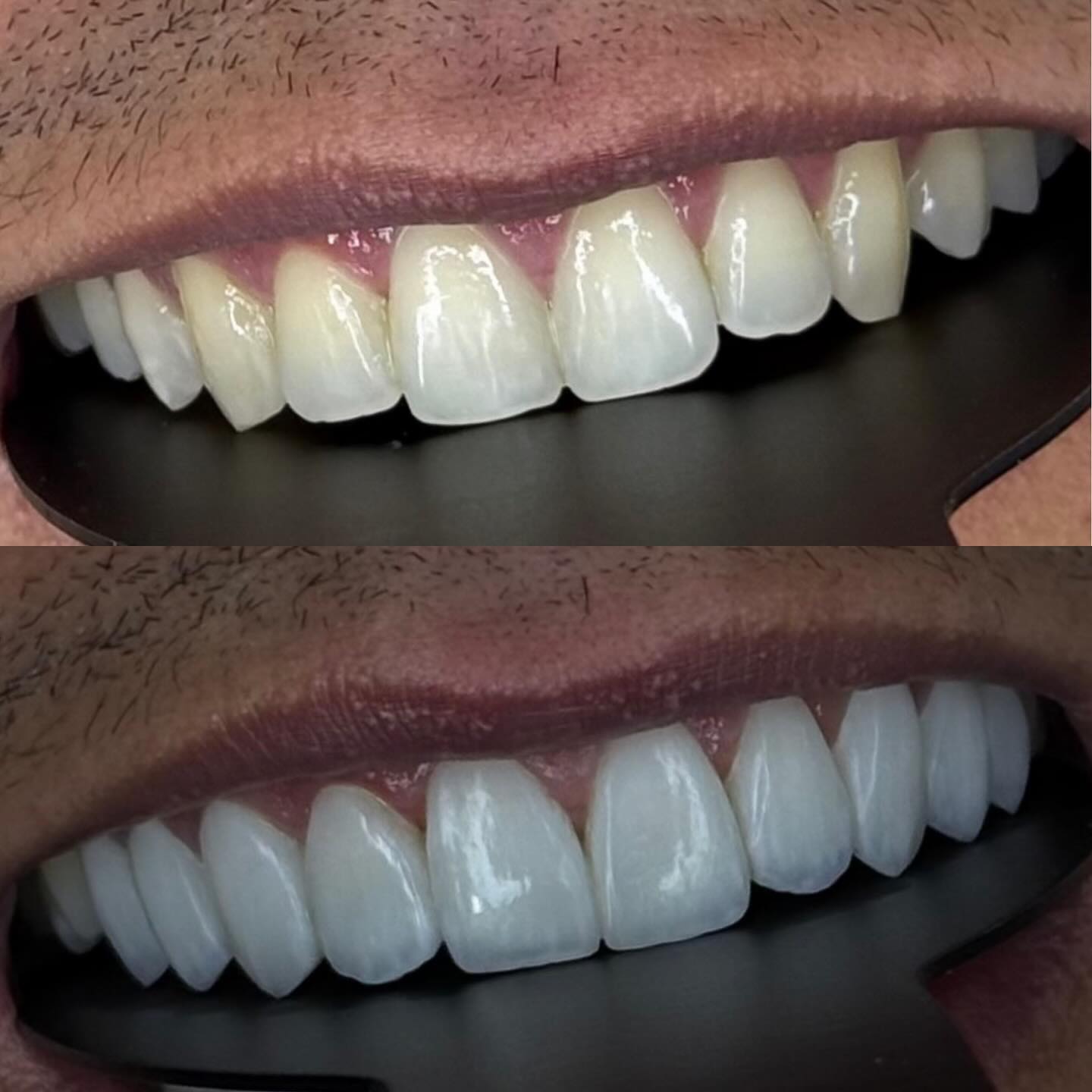 Antes e depois — caso real de faceta de porcelana