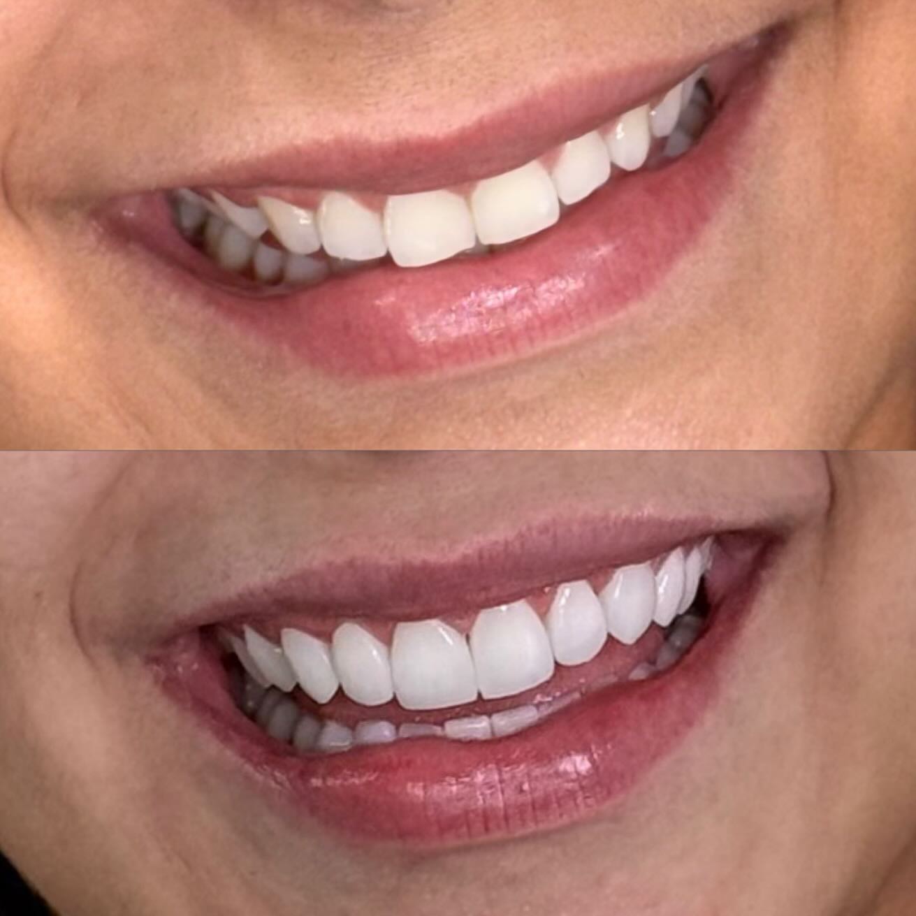 Antes e depois — caso real de tratamento estético dental