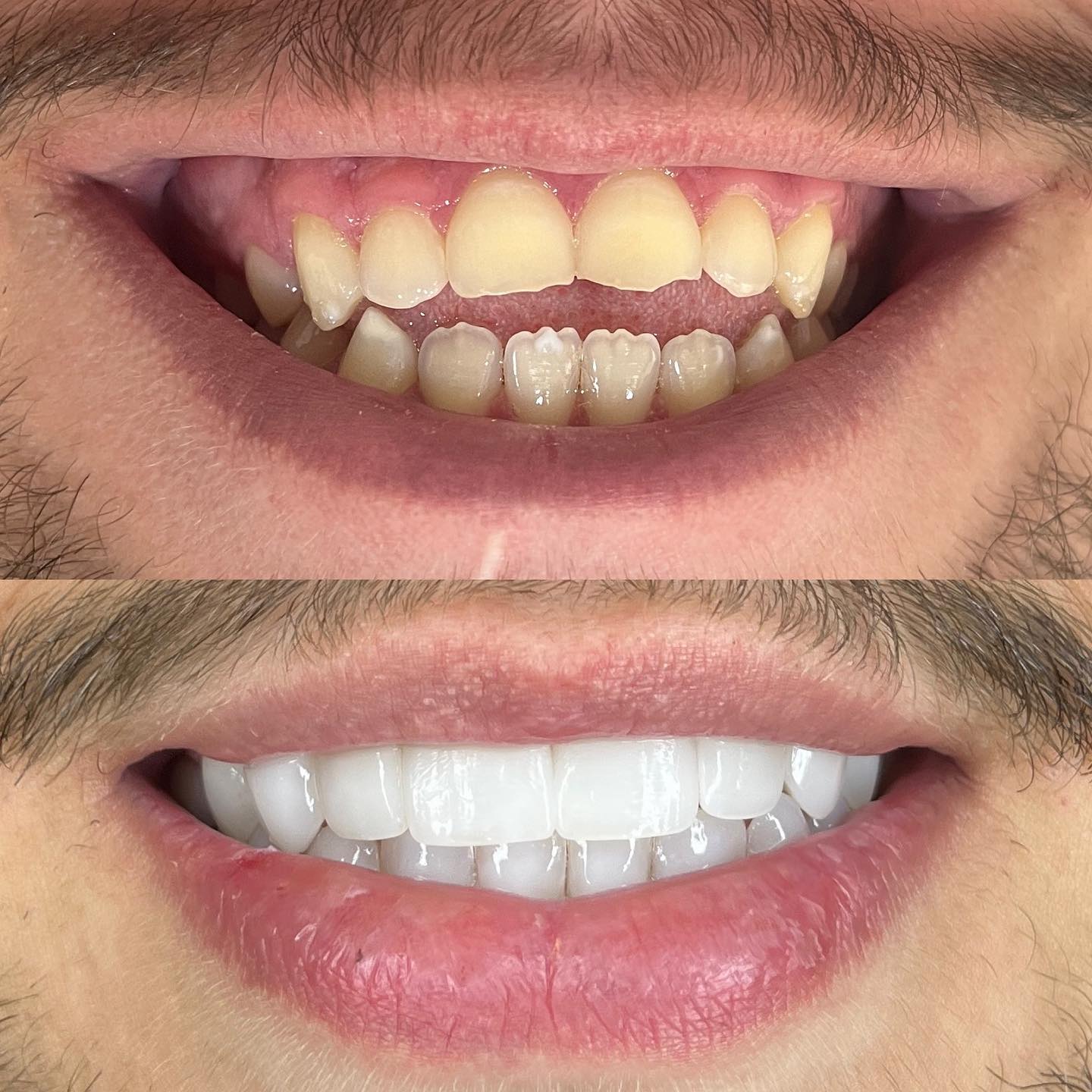 Antes e depois — caso real de reabilitação estética